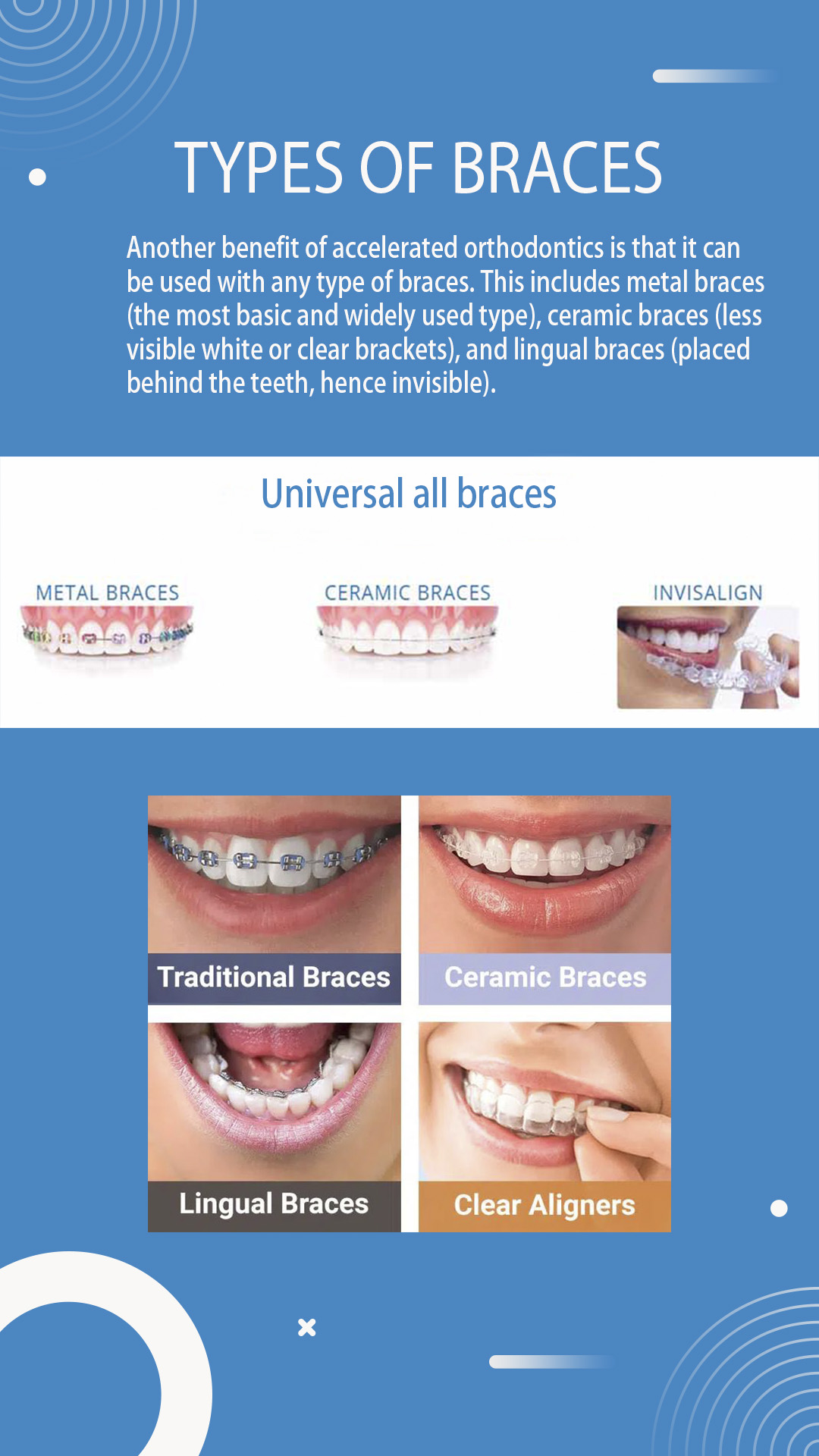 Orthodontic Accelerator|OrthoAlign™ USA|Orthodontic Treatment Aids